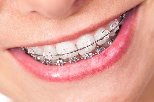 Ceramic braces