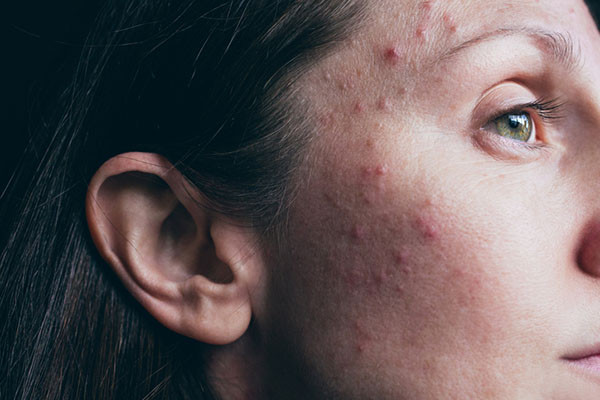 Hormonal Acne